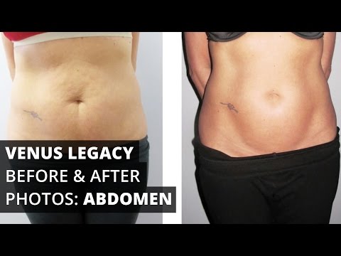 Venus Legacy™ Before & After Photos: Abdomen