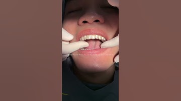 Cận cảnh bác sĩ hướng dẫn đeo hàm duy trì sau khi tháo niềng tại Tracy