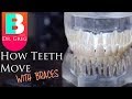[BRACES EXPLAINED] How Teeth Move / Braces Work