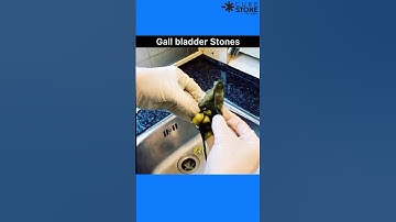 Gall bladder Stones | Laproscopic cholecystectomy | How gall bladder stones are removed