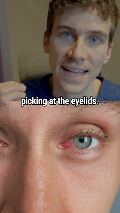 Sindrom Penangkapan Lendir Mata