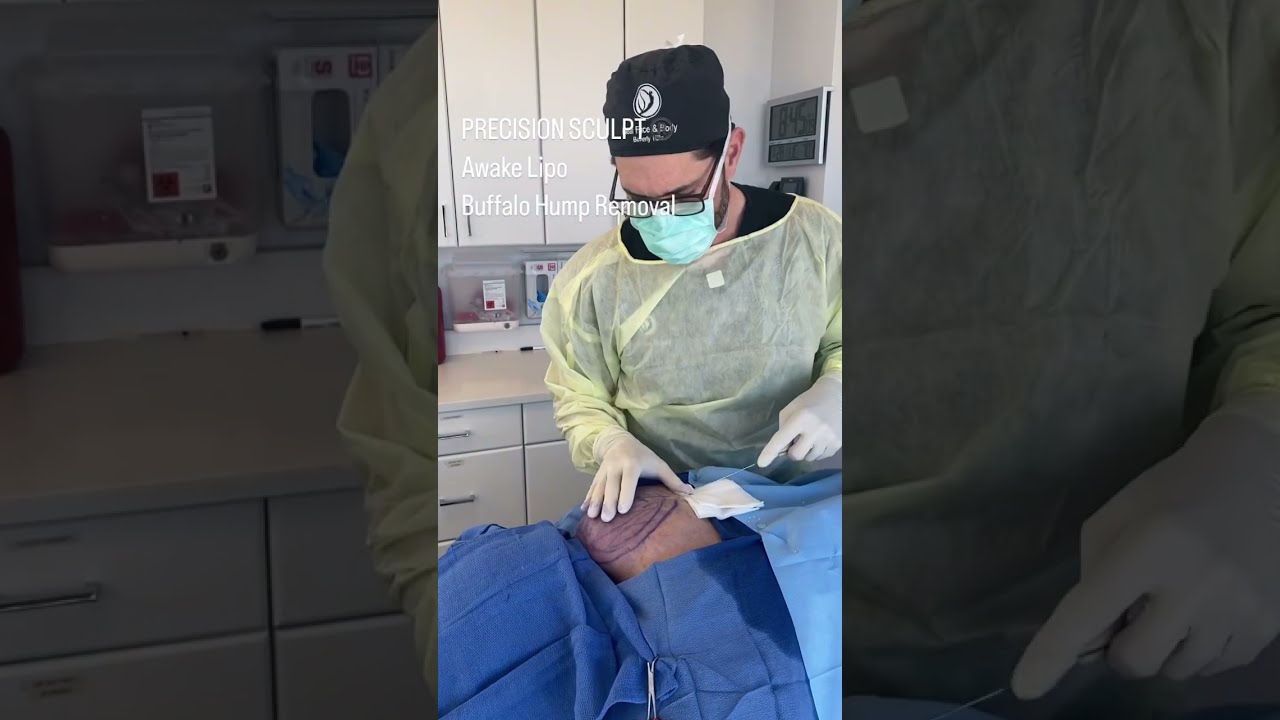 Awake Buffalo Hump Removal! PRECISION SCULPT®️ complete removal of the excess fat pad. #buffalohump