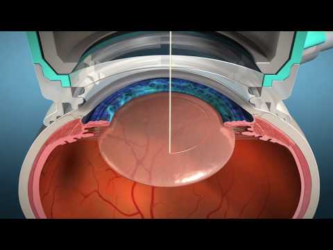 Alcon LenSx Laser - Laser Cataract Surgery, Cataract Surgery, FLACS
