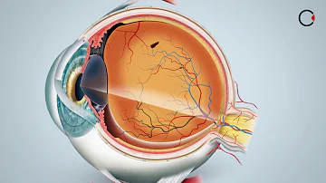 O que é retina fina?