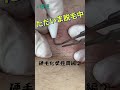 硬毛化した毛の医療ニードル脱毛(女性肩編)2#Shorts