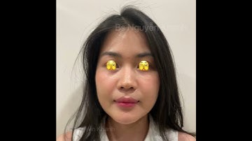 Phẫu thuật nhỏ nhưng thay đổi lớn với pp độn cằm mới, hạn chế đc lõm 2 bên cằm như pp cũ.