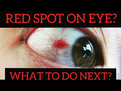 RED SPOT ON YOUR EYE| WHAT TO DO NEXT? | VINOD EYE CENTRE