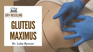 Dry Needling Gluteus Maximus