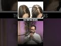 Female HAIR Transplants Are Real 👩🏻‍🦰 Hair Expert #shorts