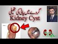Cyst in kidneys and its management  by dr shoaib mithani
