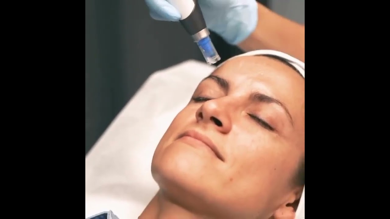 Results in the skin's appearance and texture after just one DP4™ microneedling session.