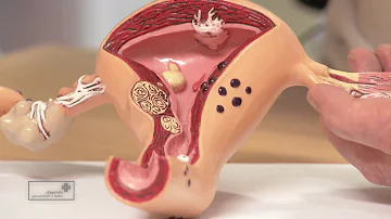 Welche Organe kann Endometriose befallen?