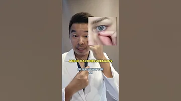 Dark Circles Under Your Eyes 