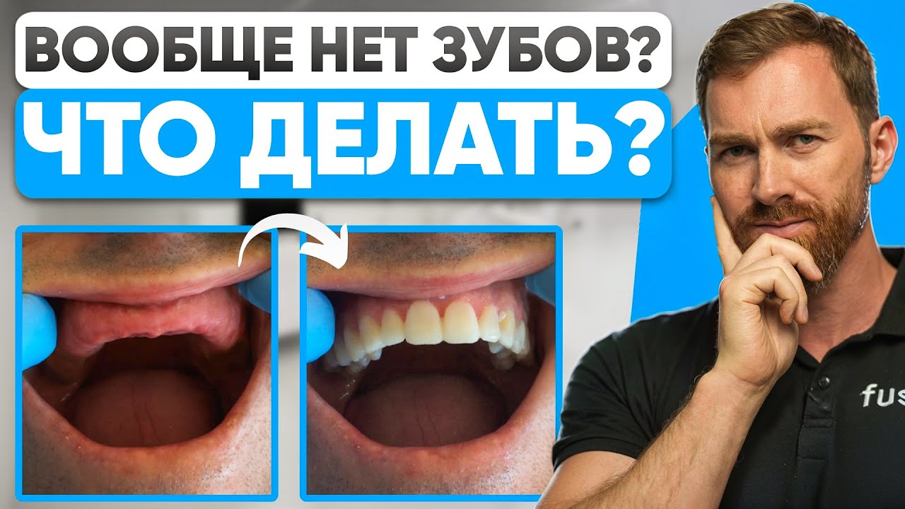 ДЕЛАЙТЕ ЭТО, если у вас нет зубов! Можно ли поставить импланты на все зубы?