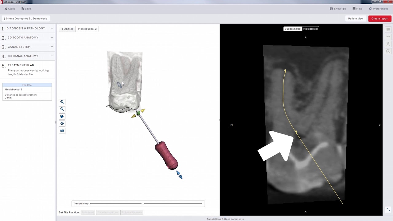3D Endo Access Refinement 8 Dentsply Sirona YouTube