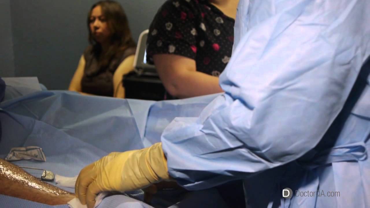 What are sclerotherapy side effects? - Dr. Dr. Mel Ghaleb, MD