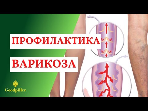 Профилактика варикоза. Всё о варикозе.