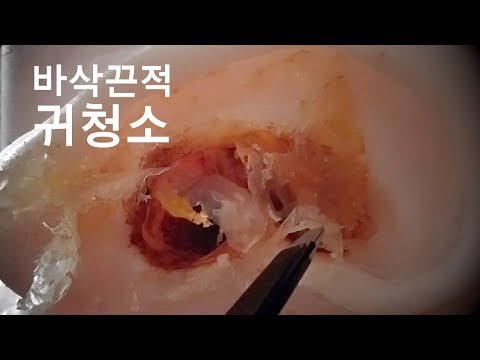 ASMR Ear Cleaning | Peel off | Suzevi