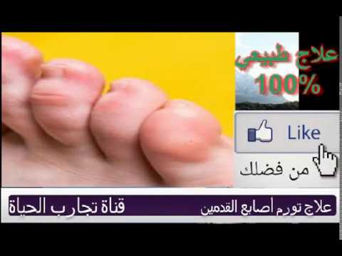 علاج تورم اصابع القدمين طبيعي 100 علاج الالم علاج التورم وأثار التورم