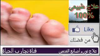 علاج تورم اصابع  القدمين طبيعي 100% ،علاج الالم ،علاج التورم ،وأثار التورم 