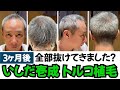 【芸能人】いしだ壱成 トルコ植毛 3ヶ月後までの経過【植毛大使｜治療｜薄毛の窓口】