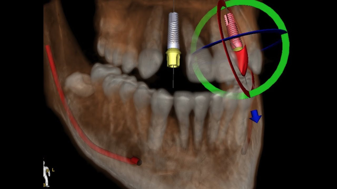 Dr. Erik uses 3D imaging, AI software, and digital planning to ensure dental implant accuracy.