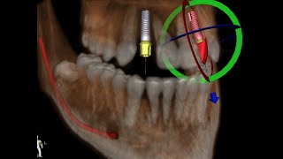 Digital Dental Implantology