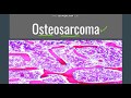 Osteosarcoma: General,Morphology, Subtypes,Clinical features