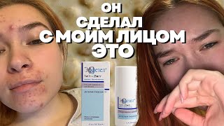 картинка: как я вылечила кожу? акне. моя история.