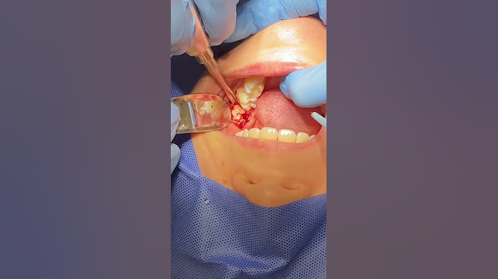 Mira cómo sacan las muelas del juicio nuestros profesionales, en Dentistas por Chile