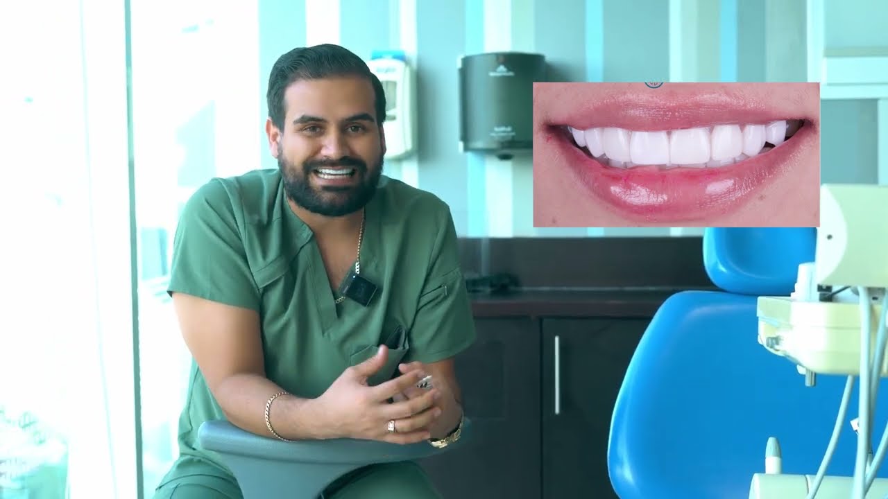 Carillas de resina vs carillas de porcelana ¿Cuál es mejor?