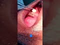 Niche ki badi daad mein masala bharna mandible right side 7 number mother filling#dental 🦷