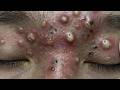 Feel The Extraction Through The Screen | Pimple Popping #800116