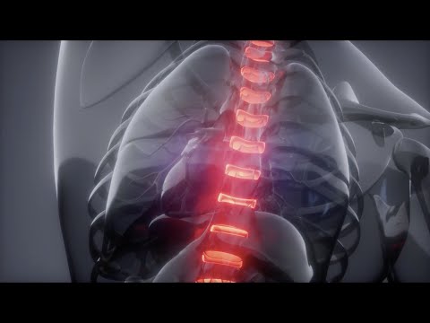 How spine tumors affect the bodies of cancer patients | OSUCCC – James