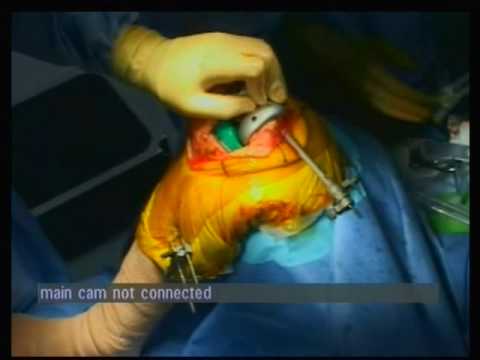 Total Knee Arthroplasty - Rotating Platform High Flex Knee - Computer Assisted Surgery (Part 1 of 5)