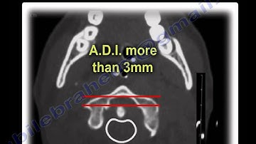 Cervical Spine injury, Transverse Ligament Injury - Everything You Need To Know - Dr. Nabil Ebraheim