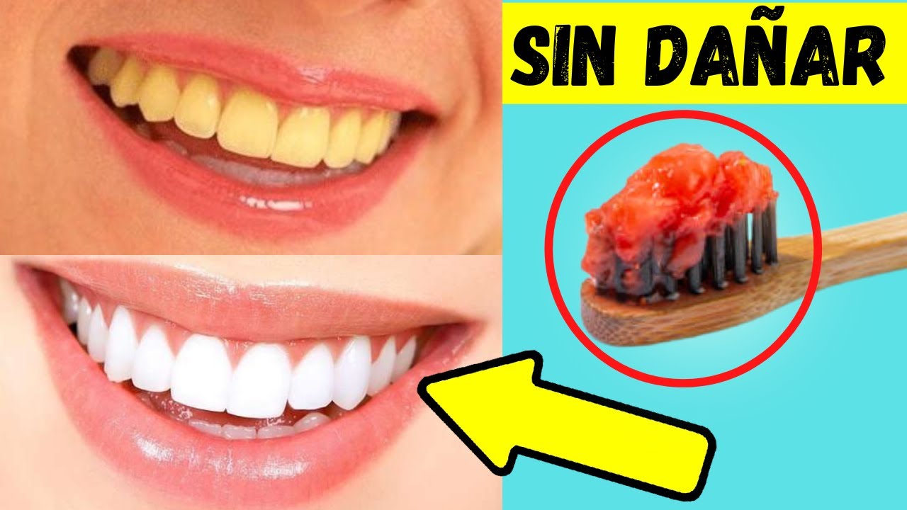 ¿Cómo BLANQUEAR los DIENTES NATURALMENTE en CASA? Sin DAÑAR el ESMALTE