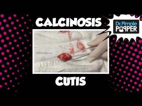 Video: Calcinosis Cutis: Behandling, Diagnos, Orsaker Och Symtom