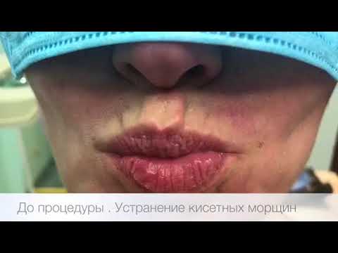 Самые эффективные процедуры против морщин над верхней губой