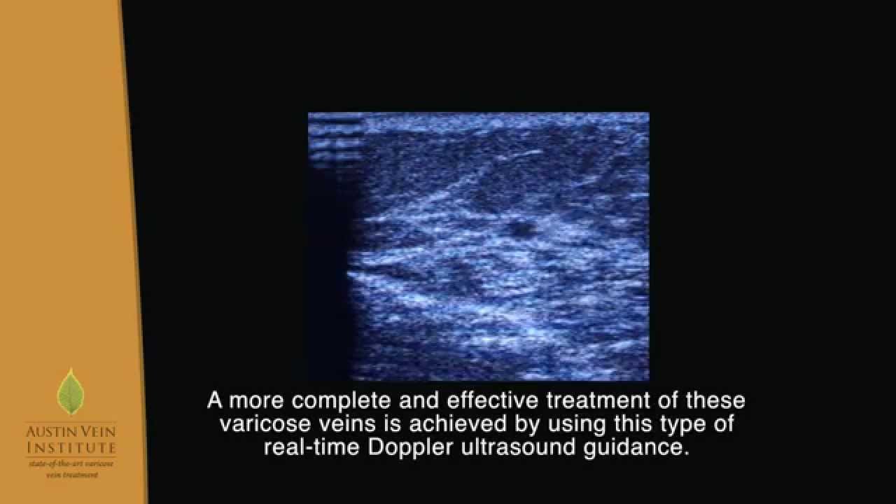 Ultrasound Guided Sclerotherapy in Austin by Dr. Chris Brennig