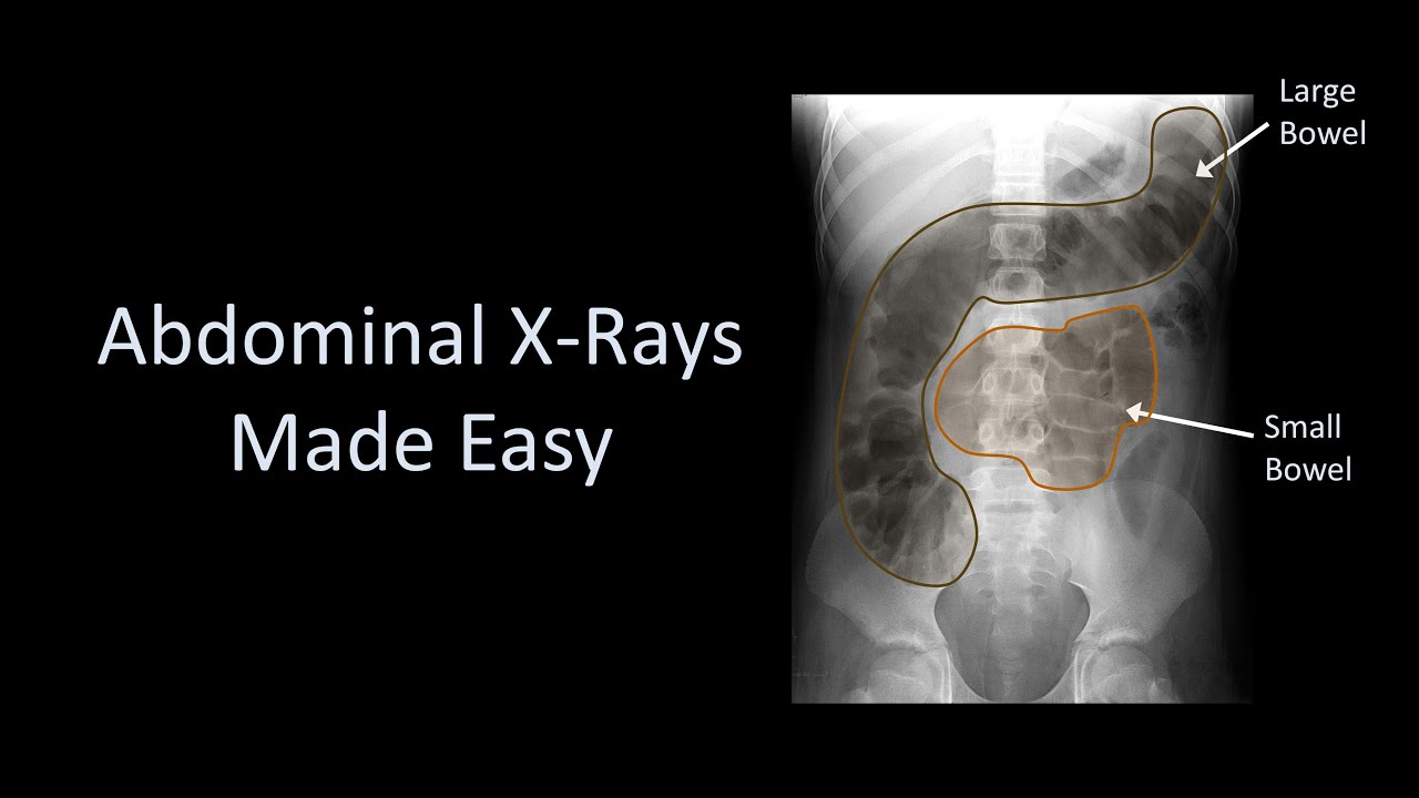 Normal Abdominal X Ray