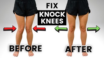 How to Fix KNOCK KNEES (without SURGERY!)