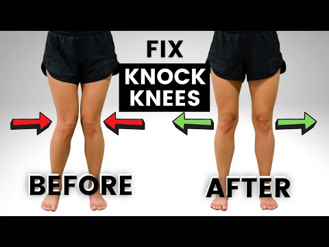 Video: 3 Möglichkeiten, Knock Knees zu reparieren
