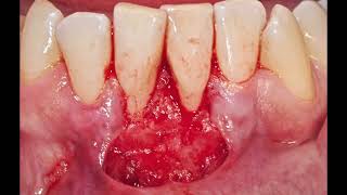 Хирургическое лечение рецессии десны 1.8