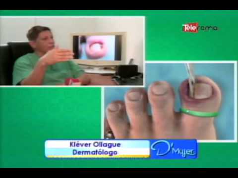 ¿Cómo prevenir uñeros?