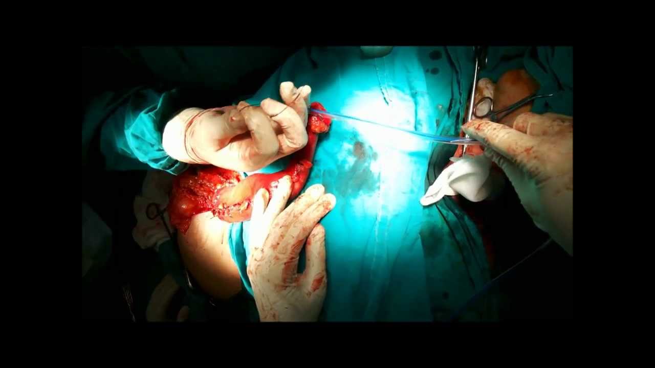 Transhiatal Esophagectomy and gastric pull up for Cancer