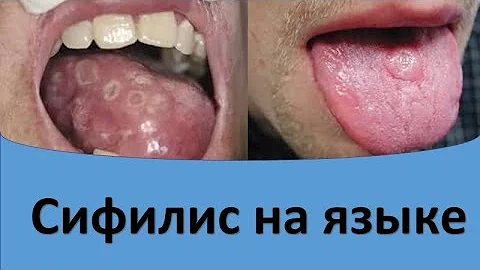 Сифилис на языке