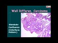 Endometrial Hyperplasia.