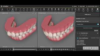 What does Invisalign Refinement look like- a real case review