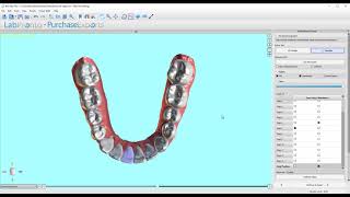 BlueSkyPlan v4.8.2.3: Clear Aligner Workflow - Step6: Movement Sequencing